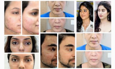 Pigmentation Treatment