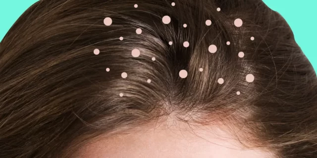 Dandruff