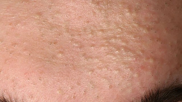 Comedonal Acne