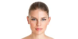 Pigmentation Treatment in Mumbai